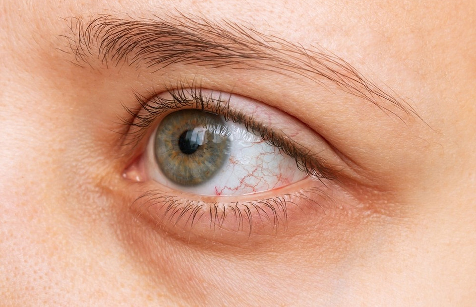 Увлажнить и устранить: как победить синдром сухого глаза (и как не сделать хуже)