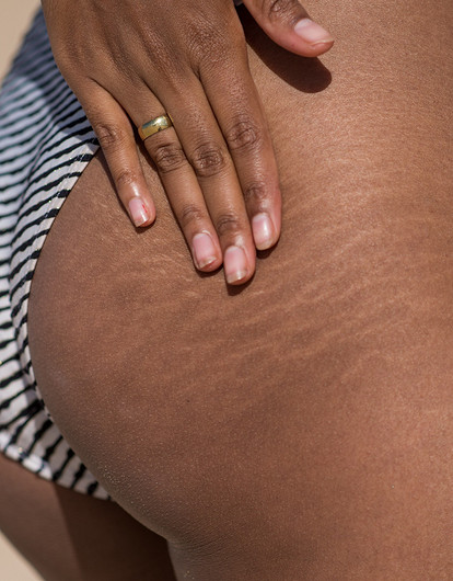 Сгладить ситуацию: главная причина появления растяжек на теле и как с ними бороться