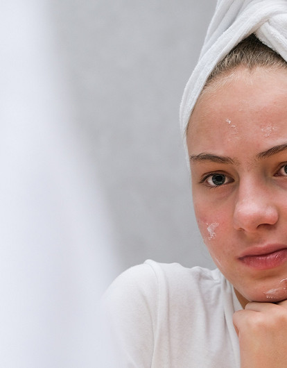 Почему косметика от акне не работает: 8 ошибок, которые можно исправить