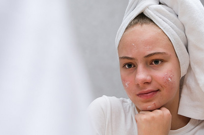 Почему косметика от акне не работает: 8 ошибок, которые можно исправить