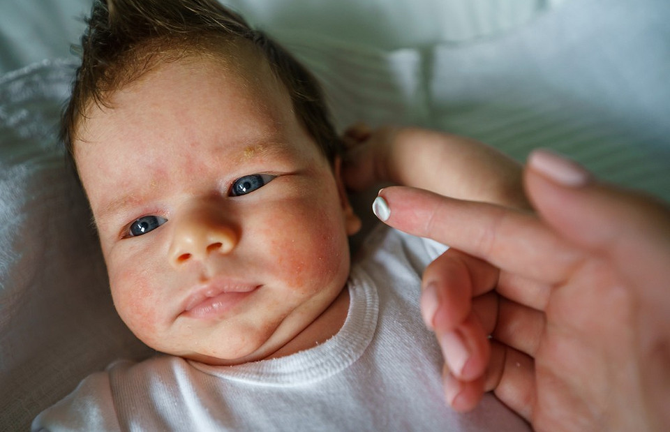 Cухая кожа у ребенка: в чем и причина и как помочь малышу (рассказывает  врач)