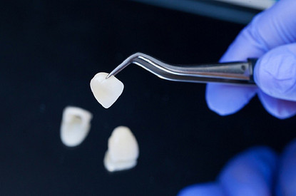 Когда что-то пошло не так: 5 главных проблем после установки виниров