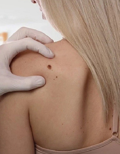 Можно ли удалять родинки, и почему летом к ним нужно присмотреться особо (отвечает эксперт)