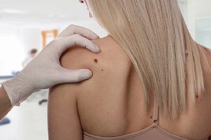 Можно ли удалять родинки, и почему летом к ним нужно присмотреться особо (отвечает эксперт)