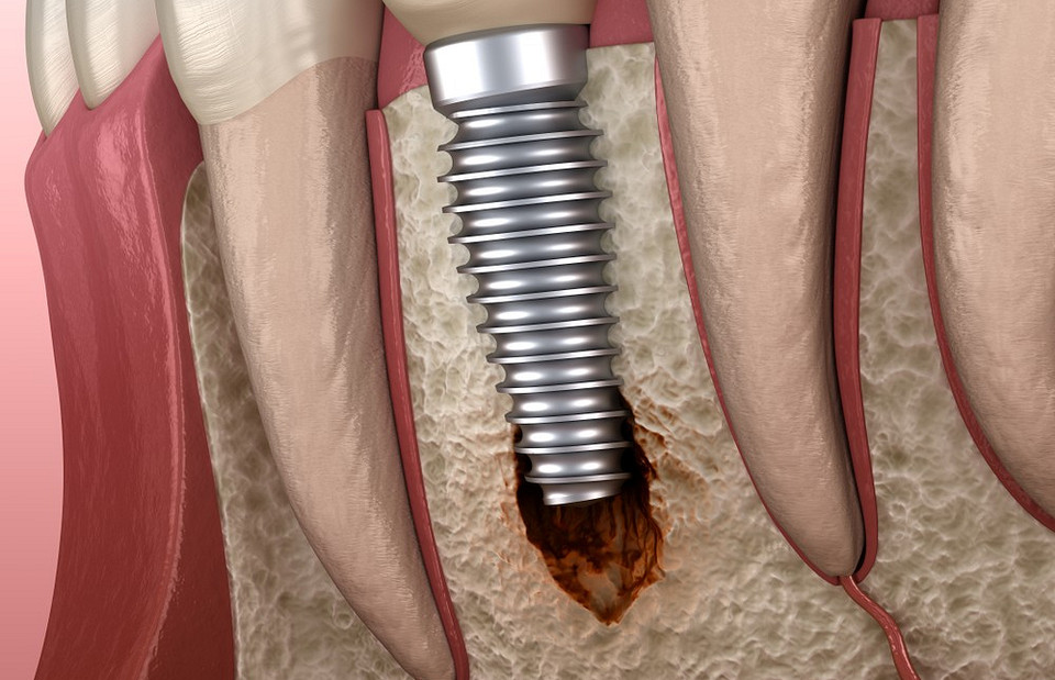 Как-то не прижилось: почему происходит отторжение зубных имплантов и что с этим делать