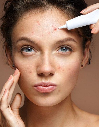 Жаркая пора для прыщей: как ухаживать за кожей с акне летом