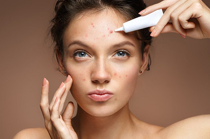 Жаркая пора для прыщей: как ухаживать за кожей с акне летом