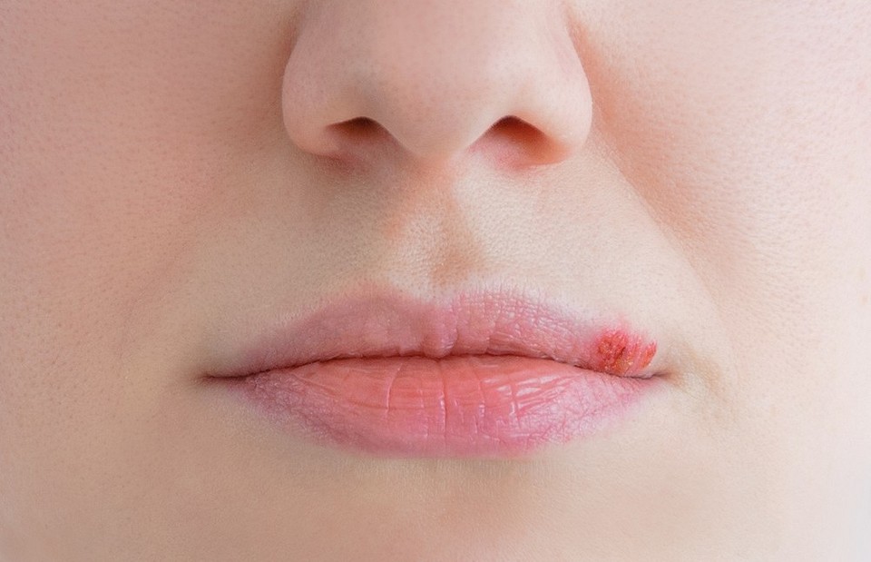 Герпес на губе: кто в группе риска и как вылечить быстро и без осложнений