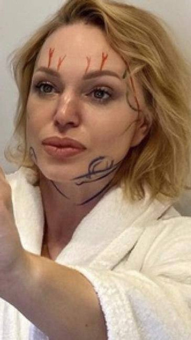 Алла Довлатова вновь сделала пластику лица: «Забрали жир из-под коленок»