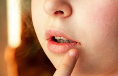 Хейлит: заеды в уголках рта у детей