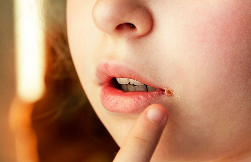 Чем лечить заеды в уголках рта: 4 главных метода и 4 самых полезных средства народной медицины
