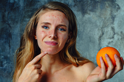 Прыщи — от бульона, отеки — от молока: нутрициолог рассказывает, как съеденное влияет на внешность