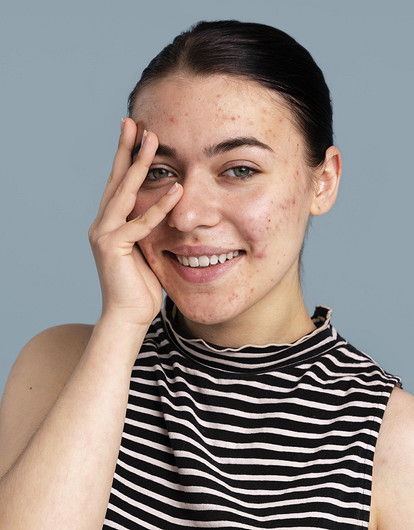 Прыщи у взрослых: 6 возможных причин и проверенные советы по лечению