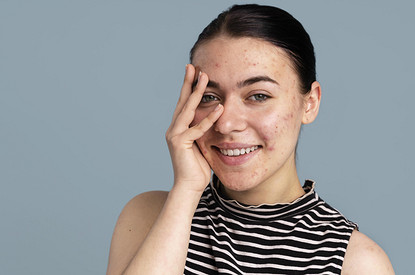 Прыщи у взрослых: 6 возможных причин и проверенные советы по лечению