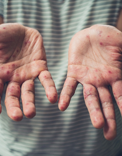 Корь у взрослых: симптомы и как быстро вылечить