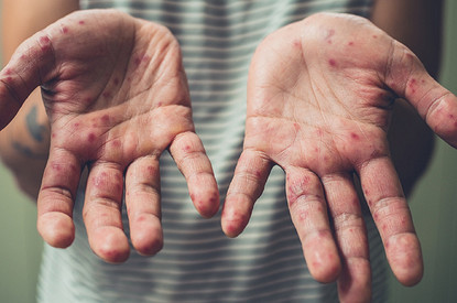 Корь у взрослых: симптомы и как быстро вылечить