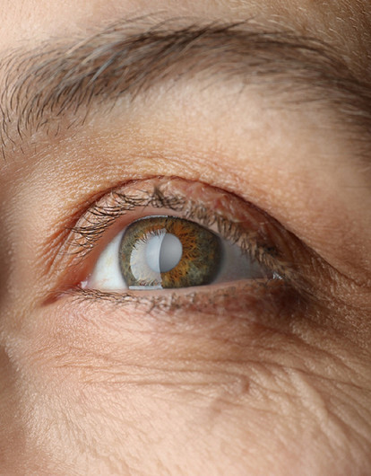 Симптомы катаракты: как вовремя обнаружить, чтобы не запустить болезнь