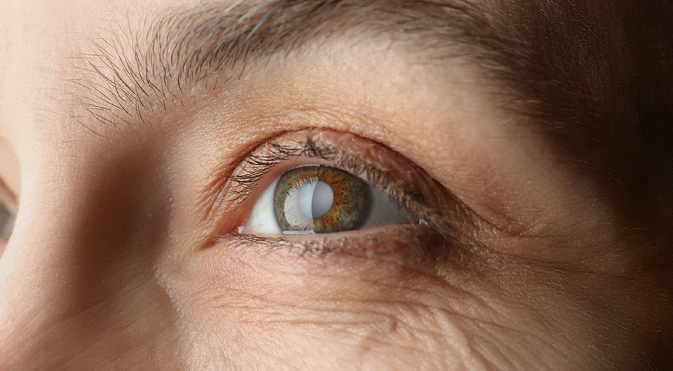 Симптомы катаракты: как вовремя обнаружить, чтобы не запустить болезнь