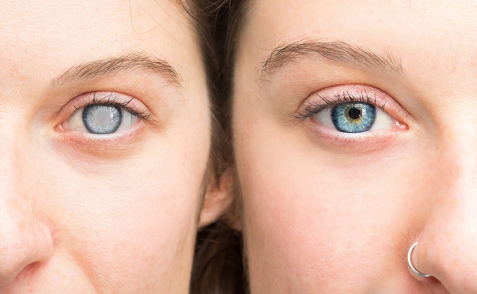 Симптомы катаракты: как вовремя обнаружить, чтобы не запустить болезнь