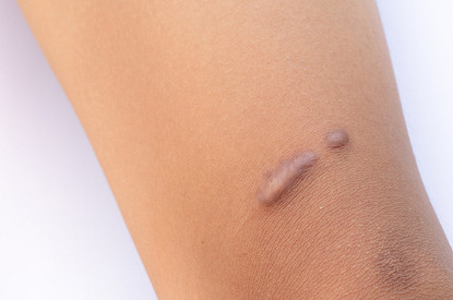 Келоидные рубцы: как избавиться от них навсегда