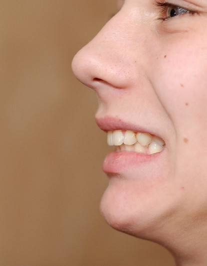 Без брекетов: как исправить прикус незаметно для окружающих