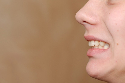 Без брекетов: как исправить прикус незаметно для окружающих