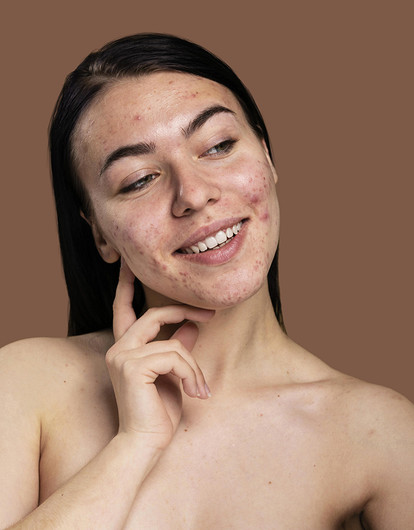 Ретиноиды от акне: спасение для кожи или вред — мнение косметолога