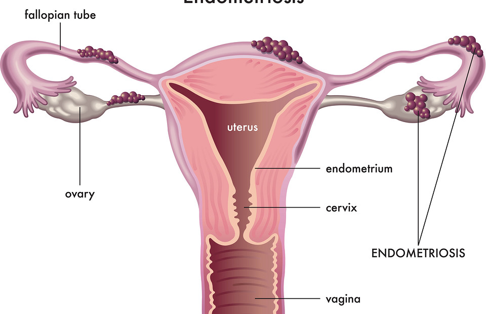 Что такое эндометриоз, его симптомы и лечение
