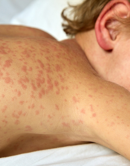 Корь у детей: симптомы, лечение и почему этой болезни так боятся
