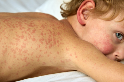 Корь у детей: симптомы, лечение и почему этой болезни так боятся