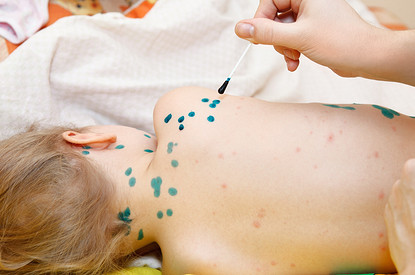 Ветрянка у детей: откуда берется, симптомы и как ее лечить