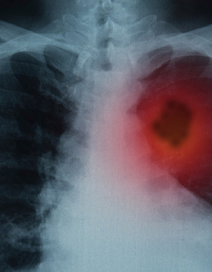 25 первых симптомов рака