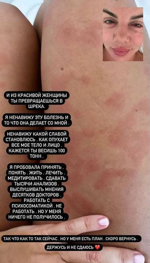 «Ненавижу эту болезнь»: Анна Седокова изменилась до неузнаваемости из-за тяжелого недуга