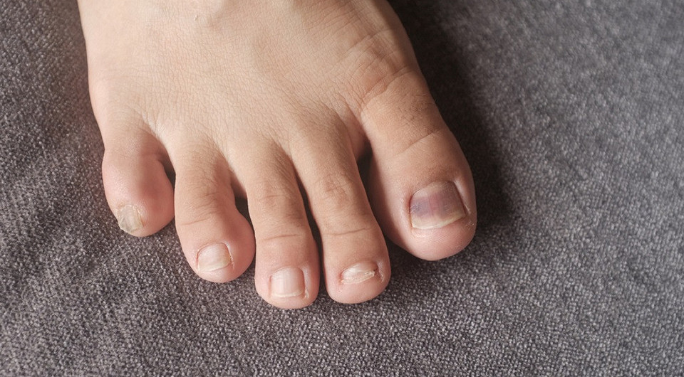 Как ускорить заживление ушиба пальца на ноге: 5 народных методов