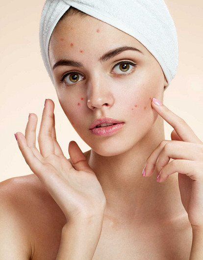 Частые ошибки в уходе за кожей, которые вызывают акне