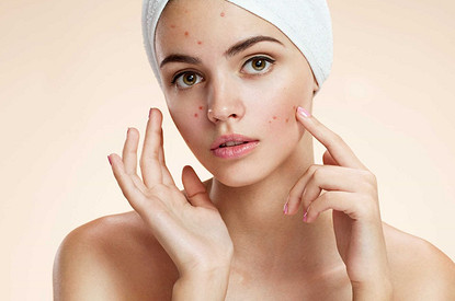 Частые ошибки в уходе за кожей, которые вызывают акне