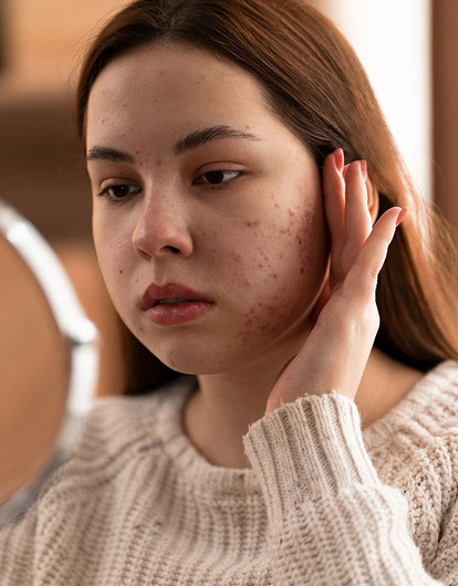 Масло чайного дерева, сера и еще 10 ингредиентов, которые стоит искать в косметике, если у тебя акне