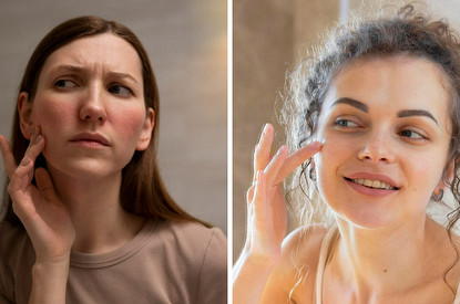 Не только сухость и раздражение: как понять, что у тебя нарушен защитный барьер кожи, и как это исправить