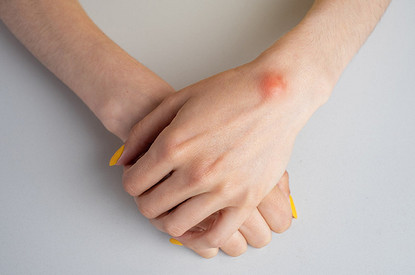 Липома: удалять или нет