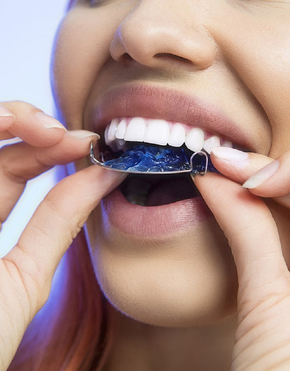 Ретейнеры: что это такое и для чего их нужно носить на зубах