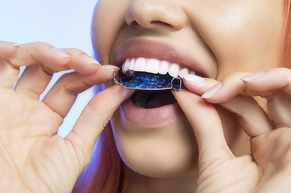 Ретейнеры: что это такое и для чего их нужно носить на зубах