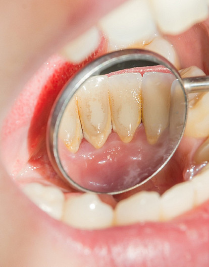 Зубной камень: что это такое и нужно ли с ним бороться