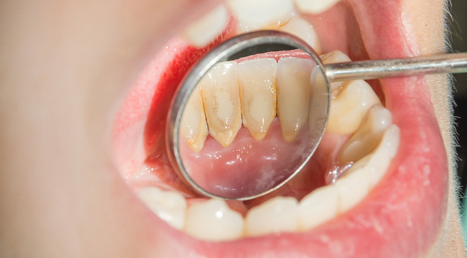 Зубной камень: что это такое и нужно ли с ним бороться