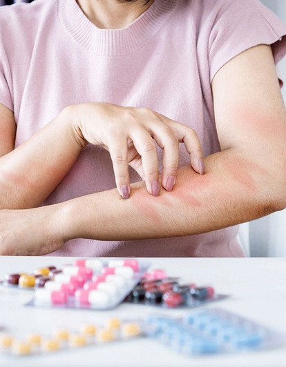 Аллергия на лекарства: как ее распознать и снизить риски появления