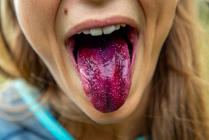 Как определить болезнь по языку: симптомы, указывающие на проблемы со здоровьем