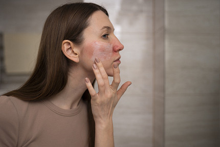Почему кожа сохнет и шелушится: 13 причин и как их устранить 