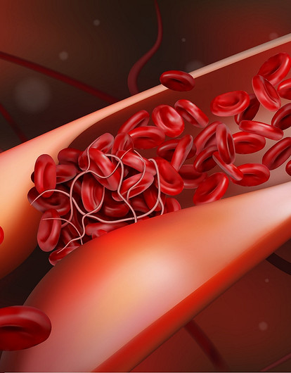 10 симптомов тромба в сосудах, которые нельзя игнорировать