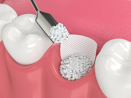 Костная пластика: что это такое в стоматологии и почему она так популярна