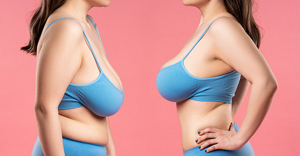 Подтяжка груди: как часто можно делать и когда не обойтись без имплантов