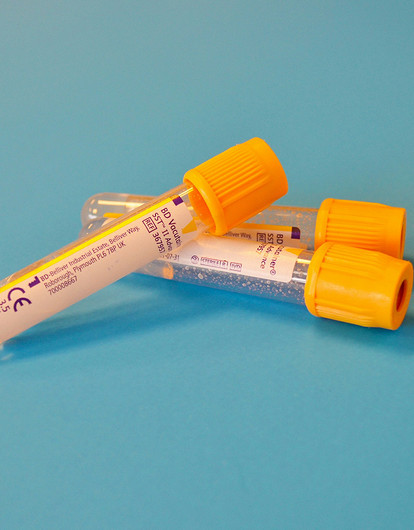 Гликированный гемоглобин: что это за показатель и какое заболевание можно предотвратить, сдав анализ